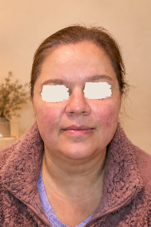 Before Kogao treatment — Lift & Glow