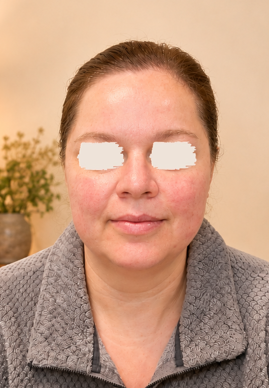 After Kogao treatment — Lift & Glow